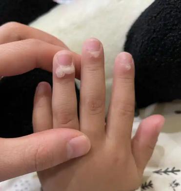 咪喹莫特乳膏去疣过程 你所需要了解的一切